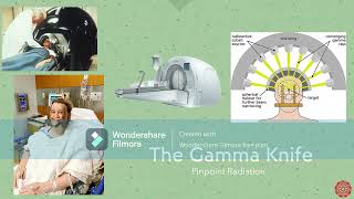 3MT Gamma Knife [upl. by Lerual120]