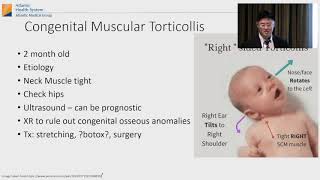 Torticollis [upl. by Yelyk447]