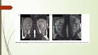 Polycystic kidney disease  Pathology  Pkd  MBBS  Medicos online [upl. by Dnomad]