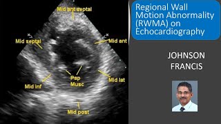 Regional Wall Motion Abnormality RWMA on Echocardiography [upl. by Isaacson]