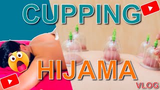 “Exploring Hijama Therapy in Muscat  My First Cupping Experience” hijama cupping muscatdiaries [upl. by Armalla]