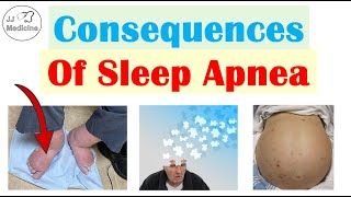 Consequences of Sleep Apnea  Cognitive Dysfunction Depression Heart Disease amp More [upl. by Palladin]