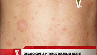 Cuidado con la pitiriasis rosada [upl. by Aihcila168]