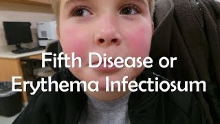 Fifth Disease or Erythema Infectiosum [upl. by Nnaasil654]