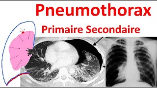 Pneumothorax spontané primitif secondaire Radiologie douleur thoracique traitement Anatomie plèvre [upl. by Matilda674]