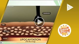 DERMAESTHETIQUE Double chin treatment using lipocavitation amp radio frequency [upl. by Guadalupe]