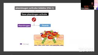 Tenecteplase in Ischemic Stroke Howd We Get Here and Where are We Going [upl. by Legir]