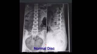 Xray ll Lumbar Spine ApLat view ll [upl. by Yenitsed]