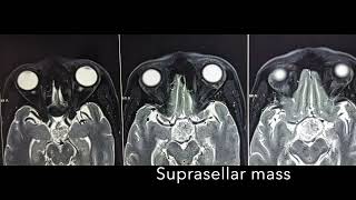 Suprasellar mass Craniophyryngioma Pterional Craniotomy Dr Akshay Vijay Kulkarni MCH [upl. by Quill]