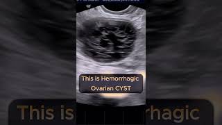 Hemorrhagic Ovarian Cyst ultrasound pregnancy [upl. by Warfore139]