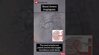 Coronary angioplasty Femoral Access [upl. by Resneps]