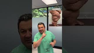 Lipedema Disease Diets Dont Work  Lipedema Awareness  Dr Boris Volshteyn [upl. by Woodruff865]