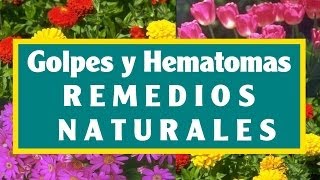 Consejos para Quitar los Moretones y Hematomas [upl. by Jacoba217]