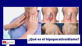 Hipoparatiroidismo diagnóstico y tratamiento [upl. by Lakin]