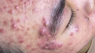 Big Cystic Acne Blackheads Extraction Blackheads amp Milia Whiteheads Removal Pimple Popping  3965 [upl. by Annaeel949]