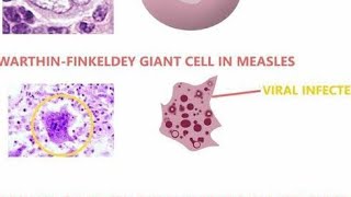 Warthin Finkeldey Giant Cells  Definition Diseases we find them in and Characteristics [upl. by Hayyifas]