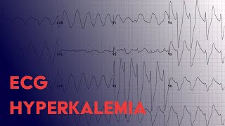 Hyperkalemia EKG Findings  ECG Interpretation [upl. by Yerga849]