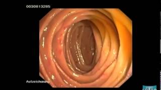 Hereditary Hemorrhagic Telangiectasia OslerWeberRendu Disease [upl. by Ardel993]