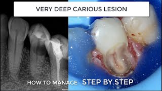 Subgingival Class V We need absolute dam isolation gingivectomy teflon and endodontics [upl. by Hike]