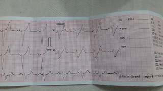 Left Bundle Branch Block ECG Findings  LBBB ECG  LB3 on ECG [upl. by Adriano]