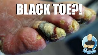 GANGRENE TOE ON A DIABETIC PATIENT [upl. by Bijan]