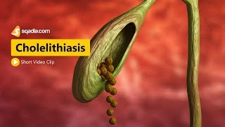 Cholelithiasis  I  Gastroenterology Medicine Animation  VLearning  sqadiacom [upl. by Rednazxela619]