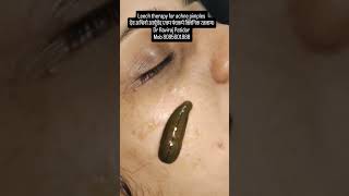 Leech therapy for achne pimples  Dr Raviraj Patidar [upl. by Nerta]