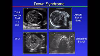 Fetal Congenital anomalies part2 [upl. by Laughlin]