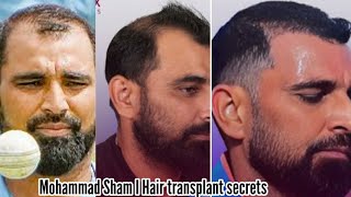 Mohammad Shami Hair Transplant Shami undergoes Hair Transplant ahead of Aisa Cup hairtransplant [upl. by Abelard]