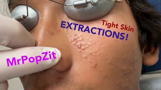 Tight skin acne extractions Comedonal acne with some inflammatory nodules Great session must see [upl. by Cynthia]