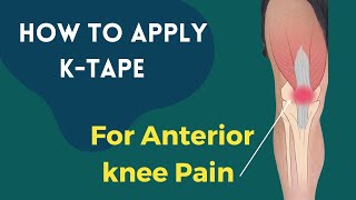 How to treat Knee Pain Patellofemoral Pain syndrome using Kinesiology tape [upl. by Fairman438]