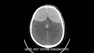 HEMATOME EXTRADURAL AIGU hospital femmemedecine radiologystudent [upl. by Eicram]