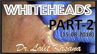 ANTI ACNE TREATMENT PART2 BY DRLALIT KASANA15082018 [upl. by Nommad664]