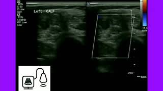 Popliteal Compartment Syndrome Ultrasound [upl. by Sana256]