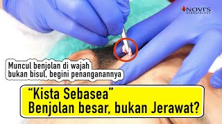 KISTA SEBASEA  NOVIS DERMATOLOGY Klinik Kecantikan Bekasi [upl. by Noj228]