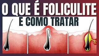 O que é Foliculite e como tratar [upl. by Frodin]