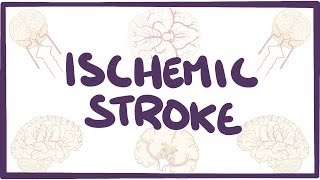 Ischemic Stroke  causes symptoms diagnosis treatment pathology [upl. by Ariaet]