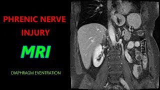 PHRENIC NERVE INJURY MRI  Paralyzed Diaphragm  Eventration [upl. by Biel572]