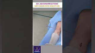 ACL Reconstruction Arthroscope Insertion Procedure shorts [upl. by Anillehs890]