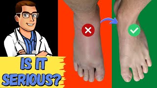 How To Tell If My Foot or Ankle Injury is BAD Sprained or BROKEN [upl. by Aneloj11]