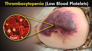 Thrombocytopenia Causes Symptoms and Treatment 3d Animation  low blood platelets [upl. by Nnalorac]