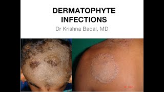 Dermatophyte infections of Skin [upl. by Kcin]