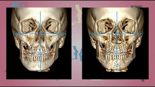 Case 14  Orthognathic surgery  Facial Asymmetry  English [upl. by Ojillib883]