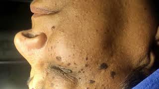 Seborrheic Keratosis treated by Electrosurgery [upl. by Netsirc]