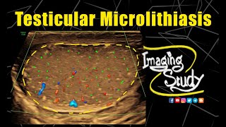 Testicular Microlithiasis  Ultrasound  Case 334 [upl. by Douglass]