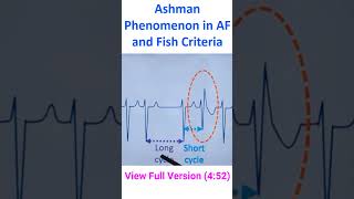 Ashman Phenomenon in AF and Fish Criteria [upl. by Aleda]