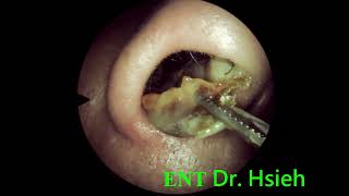 ENT local treatment after RT 3 weeks 010 鼻中膈鼻道成形手術術後三週耳鼻喉局部治療 [upl. by Clyte973]