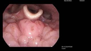 Infected Base of Tongue Lymphoid Tissue Lingual Tonsil [upl. by Nosae841]