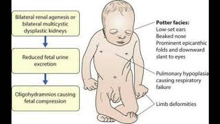 Oligohydramnios and polyhydroaminos 2 [upl. by Monjo427]