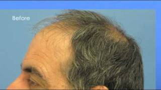 Hair Transplant Video  Dr Wong  5496 Grafts  1 Session [upl. by Areikahs]